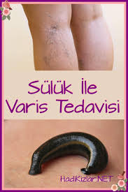 Sulukle Varis Tedavisi Varis Hersey