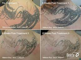 The Valley S Best Tattoo Removal With The Exclusive Picoway Laser Call 855 2delete To Receive A Complimentary Tattoo Removal Laser Tattoo Tattoo Removal Cost