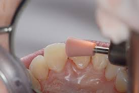 Dental composite finish and polish kit ra 4110v. Contouring Finishing And Polishing Anterior Composites Inside Dentistry