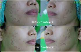 Sejak jerawatan beberapa tahun lalu, aku. Pengalaman Photo Facial Treatment Di Zap Clinic Lotte Shopping Avenue Aprijanti