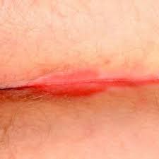 Image result for Intertrigo under breasts