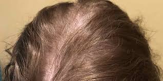 You can use folic acid supplements with biotin or zinc to prevent hair thinning, after taking medical advice. Avoid Baldness Treat Hair Loss With These Hair Masks