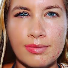 When I was a teenager I suffered from acne. It was hard to fit in and be  confident in my own skin. After my acne went, I forgot about it. Not  everyone