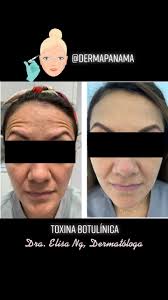 Toxina Botulínica 💉Antes y Después 👩🏻‍⚕️ #dermatologia #dermatology  #derma #panama #pty #skin #skincare #healthyskin #nails #uña #pelo #toxina  botulínica #botox #dysport #xeomin #ácido hialurónico