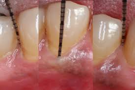 The split occurs on the multichannel tooth when periodontal infection penetrates into the area between and around the roots, which leads to the loss of alveolar process between the roots of teeth. Stages Of Periodontal Disease Bayside Periodontics Dental Implants