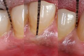 It has deep pocket that contain plaque and calculus which are the etiology of periodontal disease. Stages Of Periodontal Disease Bayside Periodontics Dental Implants