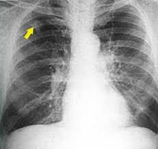 Image result for lung cancer xray