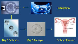 For many women undergoing iui, these. In Vitro Fertilization Ivf Specialist Irving Tx Arlington Tx Ivfmd Fertility Specialist
