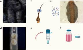 White piedra appears as white or light brown stones that loosely attach to the tip of a hair shaft and may group to form clusters. White Piedra A Rare Superficial Mycosis An Update Springerlink