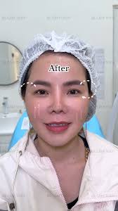 Bs Thúy chắc chắn là 99% khách hàng của mình đều sẽ hài lòng về hiệu quả mà  𝐁.𝐀.𝐏 kết hợp với 𝐇𝐀 đ𝐚 𝐩𝐡𝐚̂𝐧 𝐭𝐮̛̉ mang lại ngay sau buổi đầu  tiên. Vì không đau nhức, không bầm và không để lại vết kim sau ...