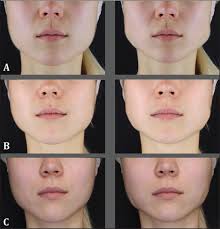 Tratamiento del bruxismo con toxina botulínica tipo A. Estudio clínico  prospectivo