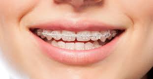 How long does a person who has recently removed braces wear the thin metal wire on the inside i guess that makes as maternal instinct to calm down. Orthodontics Maloccclusion Other Problems And Starting Treatment