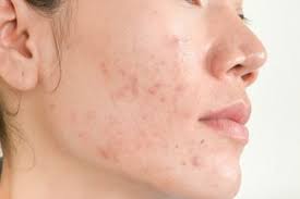 Cryosurgery merupakan prosedur menghilangkan flek hitam dengan cairan nitrogen bersuhu rendah. Noda Hitam Muncul Buat Kulit Tak Bercahaya Begini Cara Mengatasinya Semua Halaman Nakita