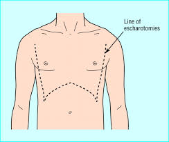 This can be illustrated in figure 3. Initial Management Of A Major Burn Ii Assessment And Resuscitation The Bmj