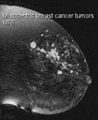 So can a woman tell if a breast lump is cancer? The Use Of Mri Scan In Breast Cancer Detection Moose And Doc