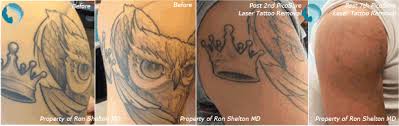 The next and most important step, according to dermatologist arash akhavan, md, founder of the dermatology and laser group in nyc: Picosure Laser Nyc Picoplus Laser Treatment Nyc Tattoo Removal Near Me