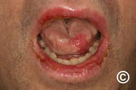 Image result for Erythema Multiforme Major