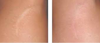 Laser resurfacing is most effective for treating superficial scars caused by acne, surgery or trauma that are not growing or getting thicker. Laser Scar Removal Evolution Md Non Surgical