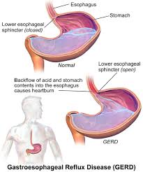 We did not find results for: What Are The Symptoms Of Gastroesophageal Reflux Disease Gerd