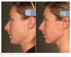 For those who cannot afford $150+ per hour to speak with a licensed professional, betterhelp offers how much experience do you have with my issue? Does Ultherapy Really Turn Back Time Review Cost Of The Non Surgical Mini Lift Dr Michael Persky