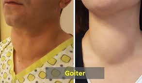 Image result for Goiter
