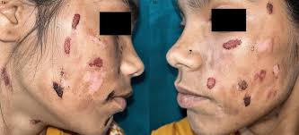 Image result for Neurotic Excoriation