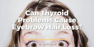 Eyebrow loss, also known as superciliary madarosis, can occur with a variety of medical conditions. Can Thyroid Problems Cause Eyebrow Hair Loss Dr Westin Childs