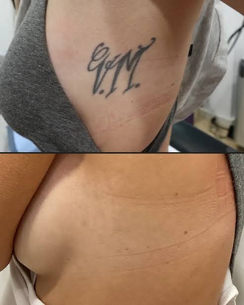 Eliminación de Tatuajes con Láser en Vigo - Centro Láser Vigo
