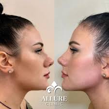 💉 Подчертаване на jawline с филъри С помощта на плътни филъри изградихме и  подчертахме ъглите на долната челюст