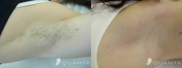 Removing the underarm hair is not only done according to aesthetics, but there are some religious beliefs, cultural beliefs, and is also a hygienic practice. Laser Hair Removal Armpit Reflections Medical