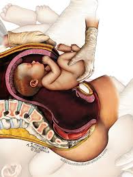 Image result for Breech Delivery