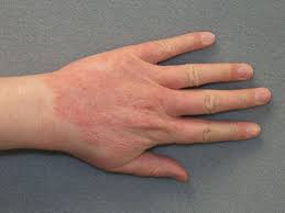 Allergic Contact Dermatitis Types Causes Treatments Allergic Contact Dermatitis Contact Dermatitis Hand Dermatitis