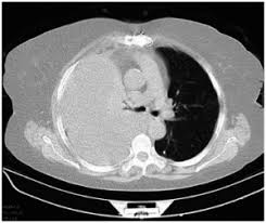 Image result for Hemothorax