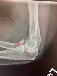 Image result for Coronoid Process Fracture
