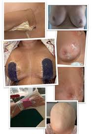 Radiation therapy for breast cancer uses high energy x rays protons or other particles to kill cancer cells. Jillian Barberie No Twitter This Is What Breast Cancer Looks Like It S Not Always A Lump Notice My Inverted Nipple On Left Breast That Was Cancer Eating My Breast From Inside Out