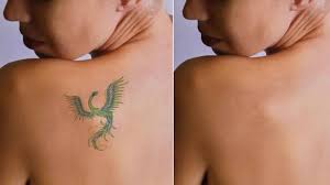 Tattoo removal can be achieved in a number of ways, ranging from laser treatments, chemical peels, dermabrasion and surgical excision. Best Skin Doctor For Laser Tattoo Removal In Delhi Dermaworld Title Dermaworld Skin Clinic