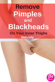 Allow your thighs to dry. Pimples And Blackheads Inner Thighs Pictures Get Rid Of Them Inner Thigh Pimples Pimples Inner Thigh