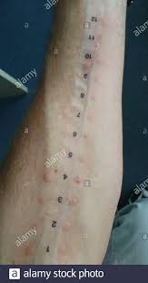 Allergie Test Stockfotos Und Bilder Kaufen Alamy