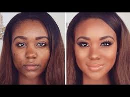 Image result for acne skin for african americans creative common