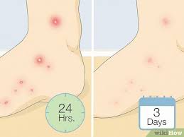 Image result for Fire Ant Sting