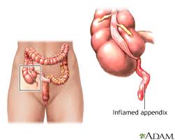 Medical illustration of appendicitis showing an inflamed appendix