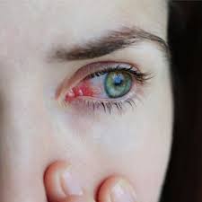 Image result for Vernal Conjunctivitis