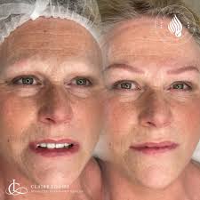 What an absolute game changer this Eyebrow Restoration Tattoo was for our  client. The aim in this instance was textured and natural. I created these  using a digital device with a perfect