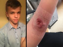 Although rare, some people can have serious allergic reaction to the bite and within seconds they. False Widow How Torquay Was Ground Zero For The Uk S Most Poisonous Spider Devon Live