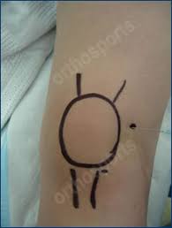 Image result for Knee Joint Injection