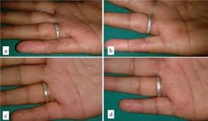 Pictures of warts on fingers. A Multiple Warts Over Dorsal Hands And Fingers B Eschar Formation Download Scientific Diagram