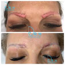 Many scar creams contain silicone, which acts to hydrate the skin, she says. Hypertrophic Scar Treatment Removal London Dr H Consult