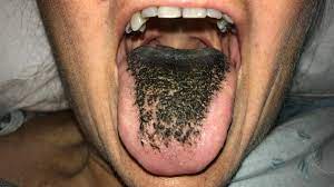 Black 'hairy' tongue? Here's what that could be | CNN