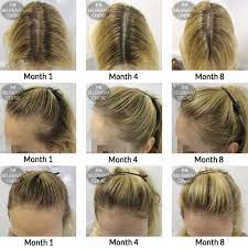 Thinning Hair Women Thinninghairwomen Hair Loss Treatment Female Pattern Baldness Treatment Hair Loss Cure