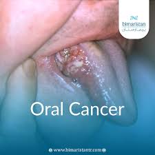 Image result for cancer of tongue